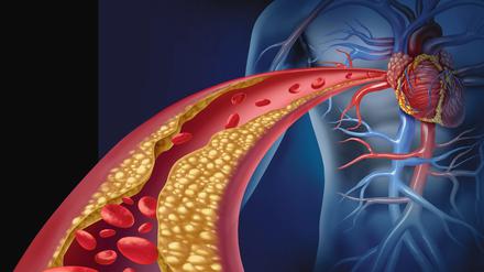 Rote Blutkörperchen strömen durch verengte Blutgefäße in Richtung Herz (Illustration).