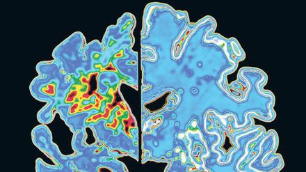 Entnervt. In Gehirnen von Alzheimer-Patienten (links) sammeln sich falsch gefaltete Amyloid-Eiweiße an (rot), dann sterben die Nervenzellen und das Gehirn schrumpft. 